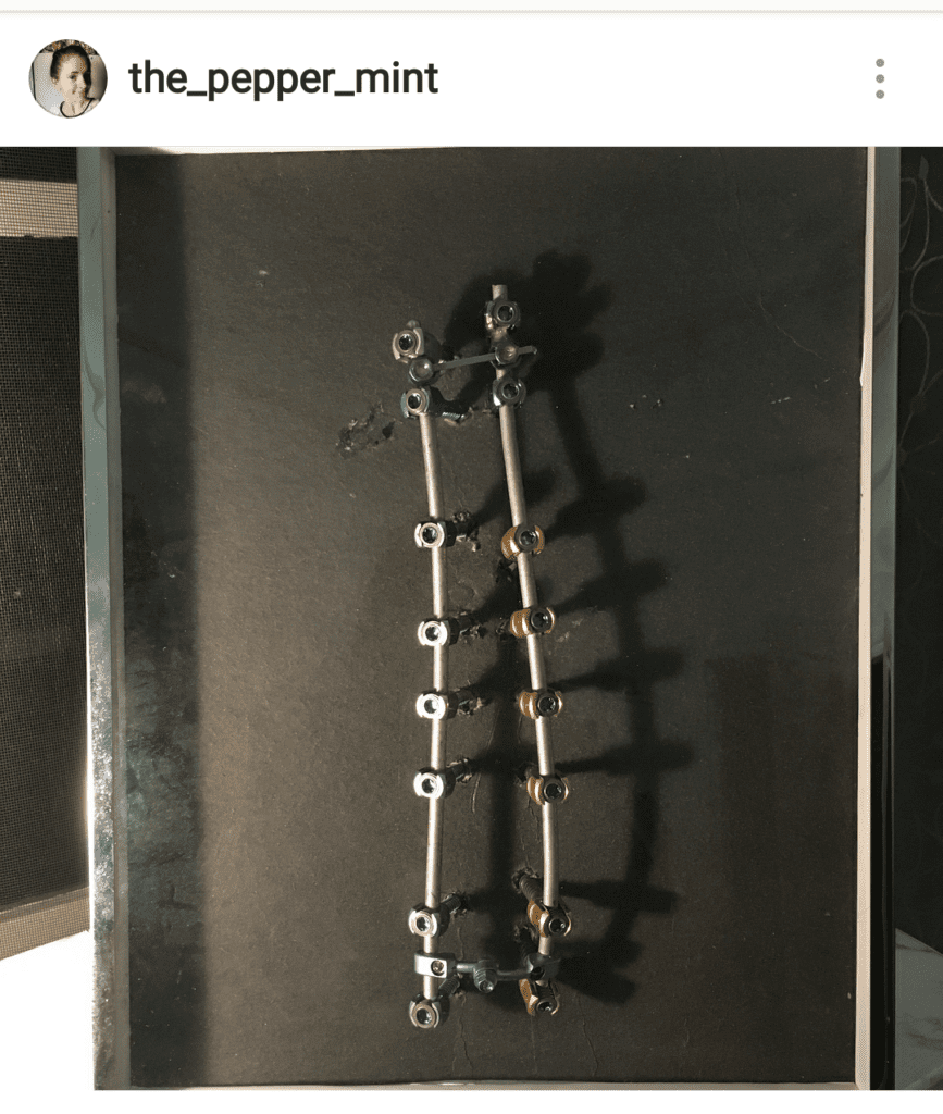 Spinal Fusion FAQ: Will I Be Able to Feel the Hardware in My Back after Surgery? | photo credit: @the_pepper_mint on Instagram