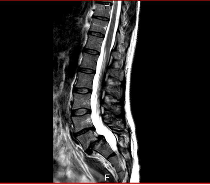 My Spinal Fusion Story: Frequently Asked Questions | Mommy Runs It